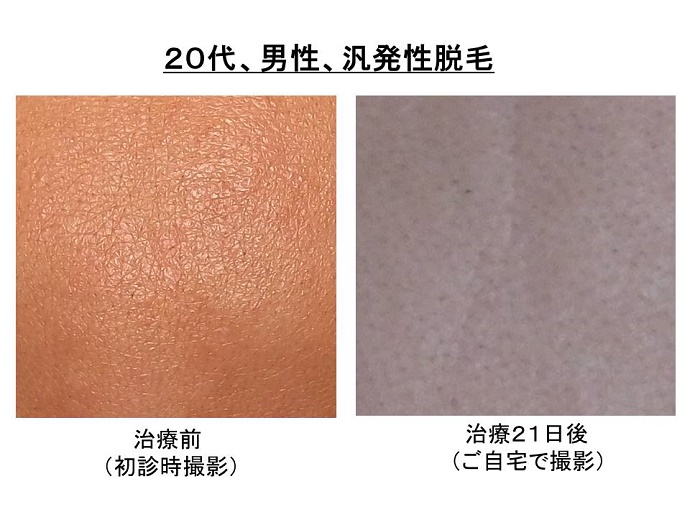 円形脱毛症　病院""